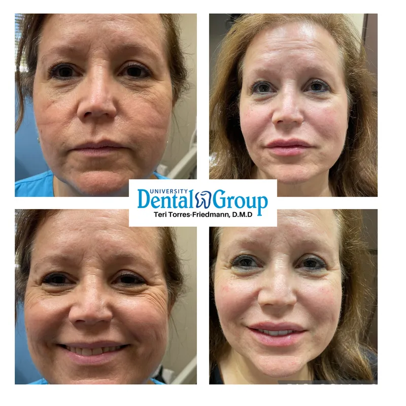 Dermal filler before and after — facial volume and contour, University Dental Group Orlando