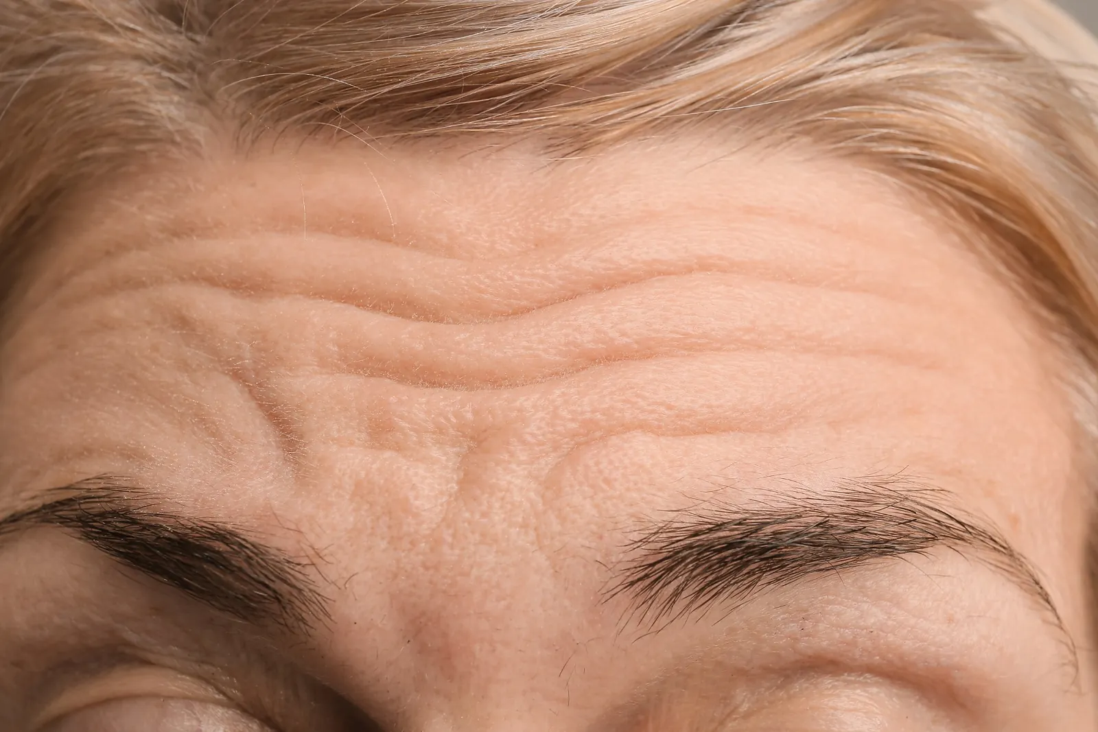Close-up of horizontal forehead lines and frown lines between the eyebrows